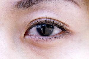 目立つ出っ歯は矯正すれば気にならない